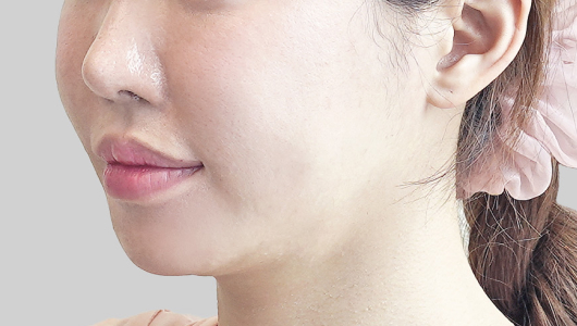 ONDA lifting face line before procedure image 3
