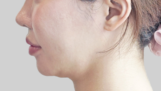 ONDA lifting face line before procedure image 4