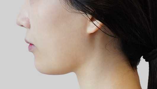 ONDA lifting face line before procedure image 5