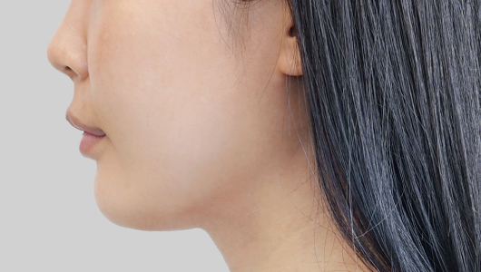 ONDA lifting face line before procedure image 6
