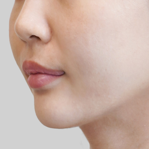 Mobile ONDA lifting face line after procedure image 1