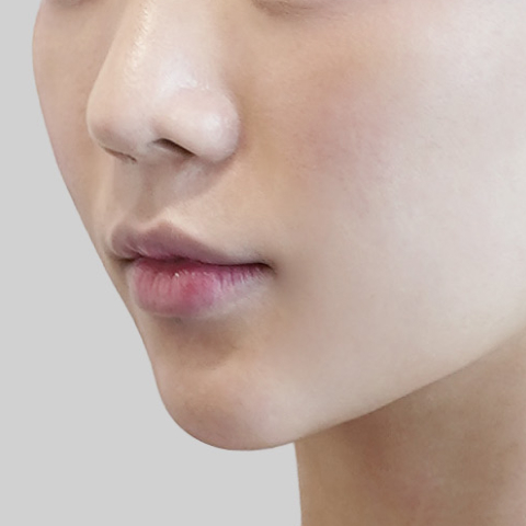 Mobile ONDA lifting face line after procedure image 2