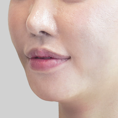 Mobile ONDA lifting face line after procedure image 3