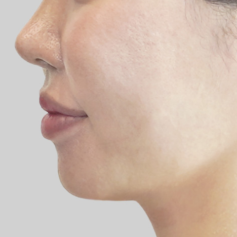 Mobile ONDA lifting face line after procedure image 4