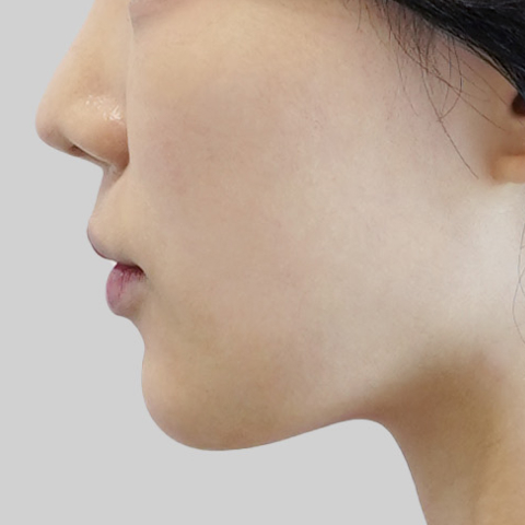 Mobile ONDA lifting face line after procedure image 5