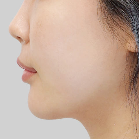 Mobile ONDA lifting face line after procedure image 6
