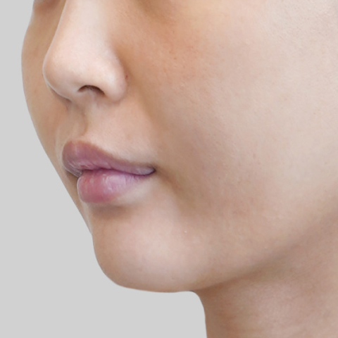 Mobile ONDA lifting face line before procedure image 1