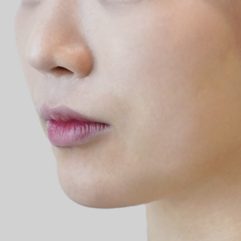 Mobile ONDA lifting face line before procedure image 2