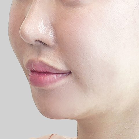 Mobile ONDA lifting face line before procedure image 3