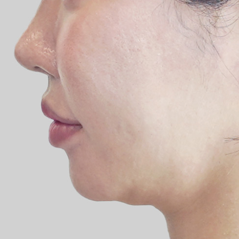 Mobile ONDA lifting face line before procedure image 4