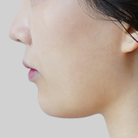 Mobile ONDA lifting face line before procedure image 5