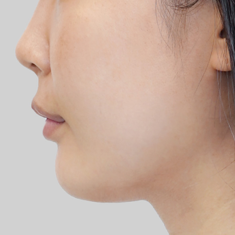 Mobile ONDA lifting face line before procedure image 6