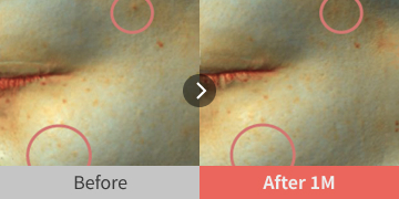 before and after images showing dark spot improvement