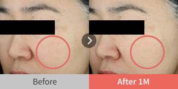 before and after images showing redness improvement