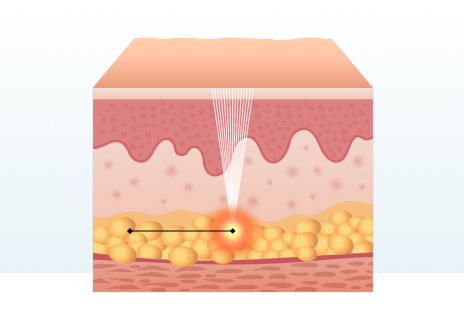 Features of Conventional HIFU Treatment