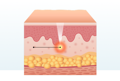 Features of Sofwave Treatment
