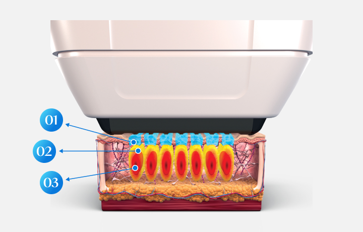 Description of Sofwave's SUPERB Technology