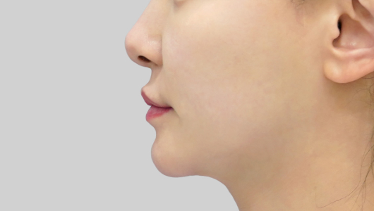 Titanium Lifting After Treatment 1