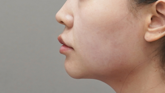 Titanium Lifting After Treatment 2