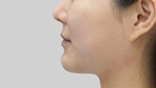 Titanium Lifting After Treatment 3