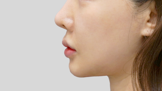 Titanium Lifting After Treatment 4