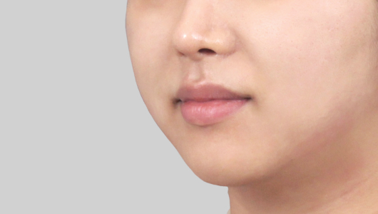 Titanium Lifting After Treatment 5