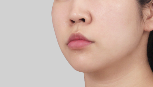 Titanium Lifting After Treatment 6