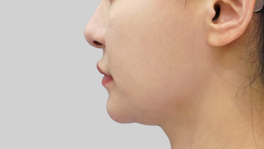 Titanium Lifting Before Treatment 1
