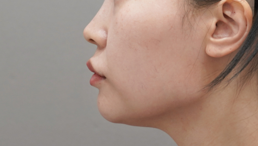 Titanium Lifting Before Treatment 2