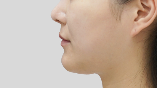 Titanium Lifting Before Treatment 3