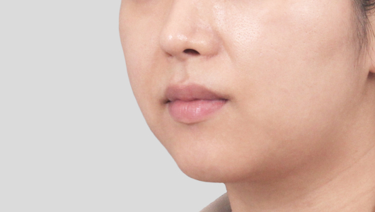 Titanium Lifting Before Treatment 5