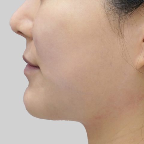 Titanium Lifting Mobile After Treatment 3